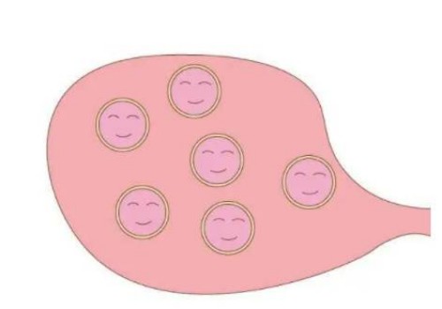 宁波试管婴儿价格：怎样解决子宫肌瘤带来的困扰？