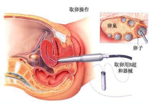 宁波试管助孕公司：试管婴儿促排时用的达菲林需要多少钱